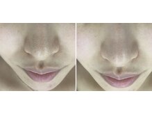 ホワイトアクア 浜松店(WHITE AQUA)/ハイドラワン/毛穴洗浄