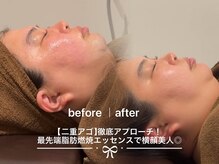 ソワン ド ブランシュ ライフ八戸ノ里店(Soin de Blanche)/元気戻りかけのむくみ、赤みケア