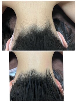 トータルメンテナンスサロン ヤマガタ(YAMAGATA)/人気パーツ！うなじ脱毛☆