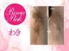 【ローマピンク/わき】夏に間に合う!1回で黒ずみ除去/夏季限定40%OFF¥132,000