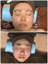 チュラ/ハイパーナイフ/所沢/痩身エステ