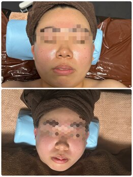 チュラ/ハイパーナイフ/所沢/痩身エステ