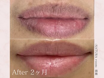 ナチュラルーム 那覇(NATURA room)/ローマピンク/リップ施術