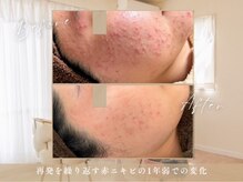 長年の肌荒れも本気ケアで変われる！変わらない人はいない…