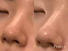 グランピュアラ 難波店/【小顔＆毛穴ケアサロン】毛穴◎
