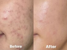 ヨソイ(yosoy)/ハーブピーリング