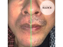 ナークス(NARX)/たった1回でもここまで変わる♪