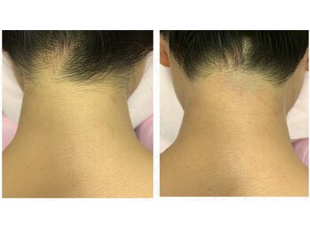 ブリリアンス(BRILLIANCE)/★ワックスでうなじ形成★