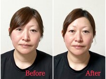 シルフィード/たるみなくなり目がパッチリ