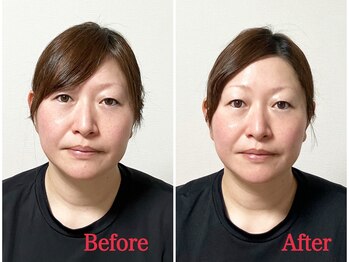 シルフィード/たるみなくなり目がパッチリ