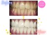 セルフホワイトニング【9分×2】¥980 別途料金無し