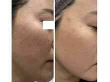 肌の赤み、毛穴の開き、ニキビ★スキンケア×インナーケア1ヶ月