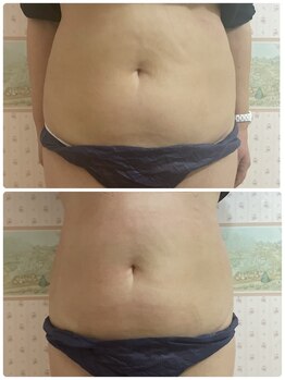 ルフレ/脂肪冷却で理想のボディへ!