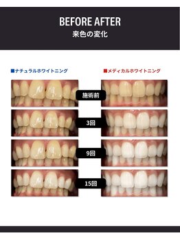 エイトバイエイト(8×8)の写真/初めての方にもオススメ！セルフホワイトニング！エリア希少の歯科医師提携店◎ご状態に合わせてご提案☆