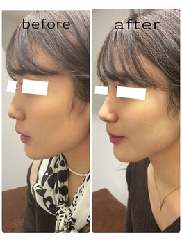 エンチャント(ENCHANT)/小顔造形