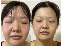 リナーシェ(RINASCe)/脂肪分解コース仕上がり♪