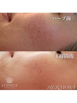 アネラ(ANELA)/エルモサハーブ症例.3