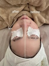 リベレスタ(liberesta)/光フェイシャル