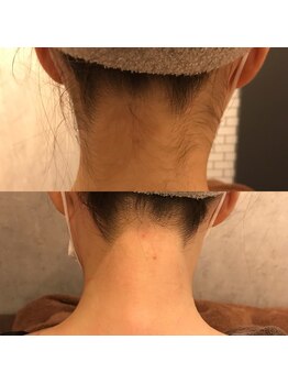 ザ シー タイムレスビューティ(THE SHE)/20代お客様症例写真