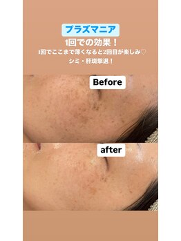 ビューティーネイル(Beauty Nail)/プラズマニア