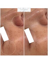 クレア(Clair)/イラストリアス症例