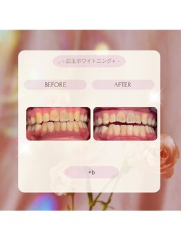 プラスビーセルフ(+b self)/ホワイトニングビフォーアフター