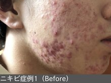 オアシスラグーン(OASIS LAGOON)/ニキビ改善（症例1 before）