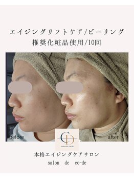サロンドコーデ(salon de co-de)/エイジングリフト&ピーリング