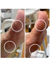 エクラプラス(Eclat.plus)/お悩みな足裏様ご来店