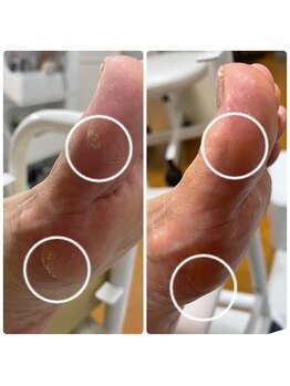 エクラプラス(Eclat.plus)/お悩みな足裏様ご来店