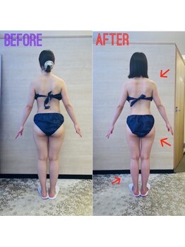 エステティックサロン アール 大阪梅田(esthetic salon R)/20代女性　後