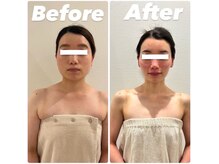 ビオール 表参道(beall)の雰囲気（最新ラジオ波WINBACK×韓国発話題のレモンボトルで最強小顔ケア）