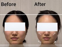 ベール(BEHL)/コルギのBefore After