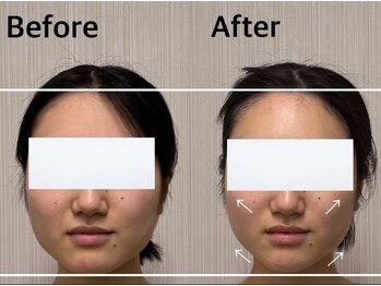 ベール(BEHL)/コルギのBefore After