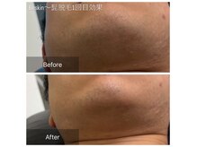 ビースキン 広島(BE:SKIN)の雰囲気（髭脱毛1回目の効果☆イオン導入しながら美肌で清潔感UPに◎）