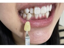 ライトビューティー 本八幡店(LIGHT BEAUTY)/難しいと言われてる犬歯も♪