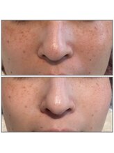 ピュア 川越店/光フェイシャル