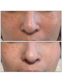 ピュア 川越店/光フェイシャル