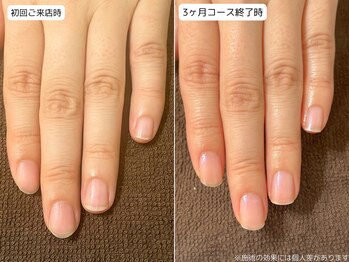 カピリナ(Ka Pilina)/自爪育成・深爪・川崎