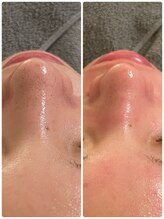 ルカシエ(Le Cacie)/20代女性/毛穴洗浄&顔脱毛