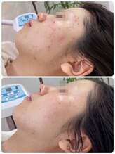 ニキビケア研究所 吉祥寺店/10代のニキビもお任せ！