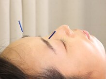 ビッグハンド/鍼灸