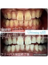 ホワイトニングサロン 名古屋 栄店/【ホワイトニング】