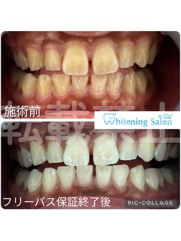 ホワイトニングサロン 名古屋 栄店/【ホワイトニング】