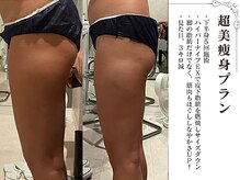 ラブミー 渋谷本店(LoveMe)/骨盤/下半身痩せ/痩身/渋谷/青山