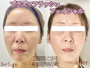 フェリマ ナナ(felyma vii)の写真/プラズマフラッシュフェイシャル　シミ・シワ・たるみ・赤み・ニキビ　最新技術で確実改善