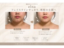 エルナ(Elna)の雰囲気（レモンボトル施術フェイスラインスッキリ）
