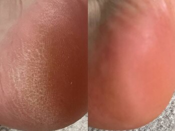 トゥー ビー(TO BE...)の写真/ガサガサかかとにフットのトータルケアで素足美人へ♪プロのケアで、角質のないなめらかな触り心地に♪