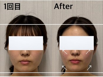 ベール(BEHL)/コルギのBefore After