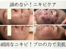 BUB 立川の雰囲気（都度払いで始めやすい本気の肌ケアニキビ予防◎丁寧にサポート）